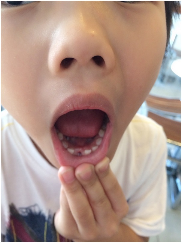 permanent teeth growing behind milk tooth