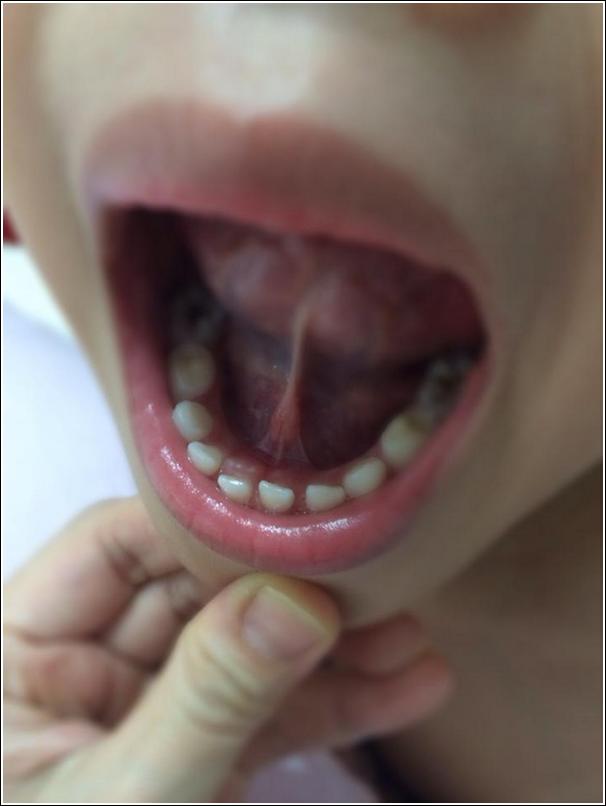 permanent teeth growing behind milk tooth_1