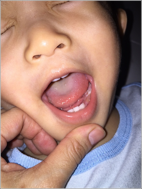 Ayden teeth at 22 month old