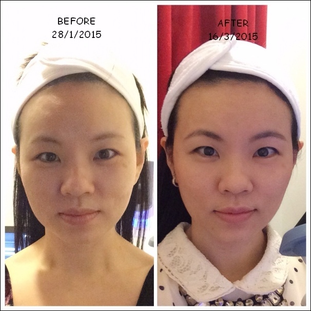 Before and After Ultheraphy picture submerryn